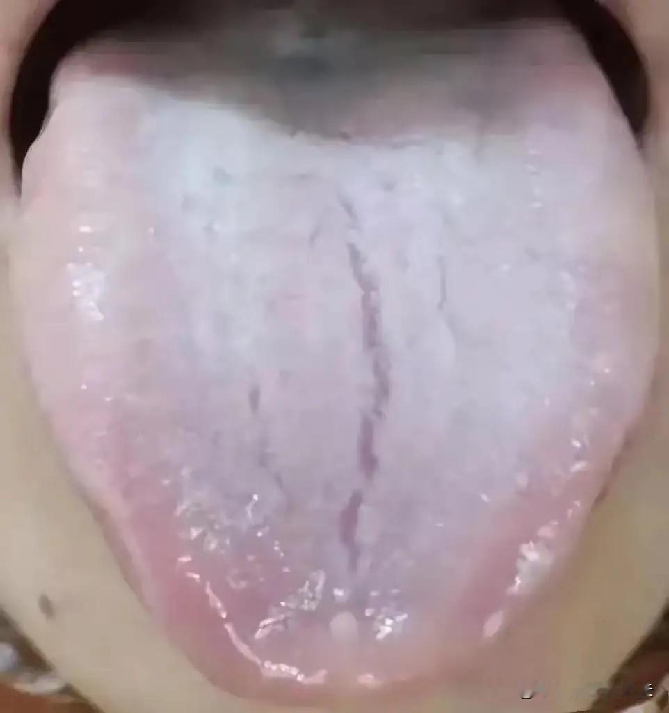像这样的舌象，一看肾精亏虚的很严重，切忌，可别再吃五子衍宗丸了！

患者主要的男