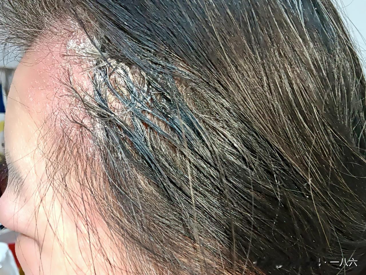 59岁邻居脸肿封喉！我全程揪心见证：名演代言的“非遗植物染发剂”竟藏致命风险！