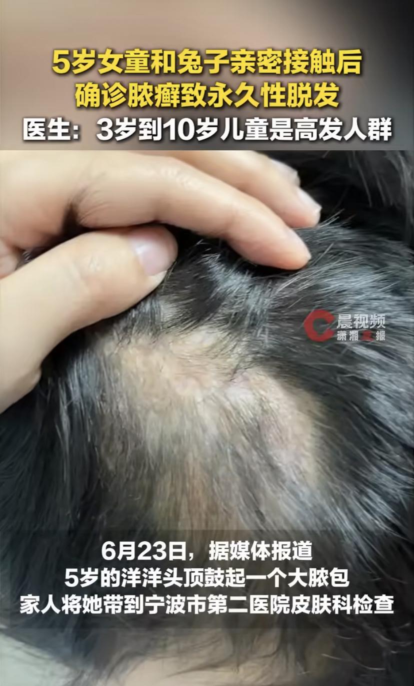 5岁女孩头顶鼓包流脓，最后那块头皮再也长不出头发了!罪魁祸首谁都想不到。
河南5