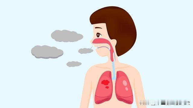 痰是肺的“检测器”3个中成药，横扫白、黄、粘痰，给肺洗洗澡！

1、黄痰
表现：