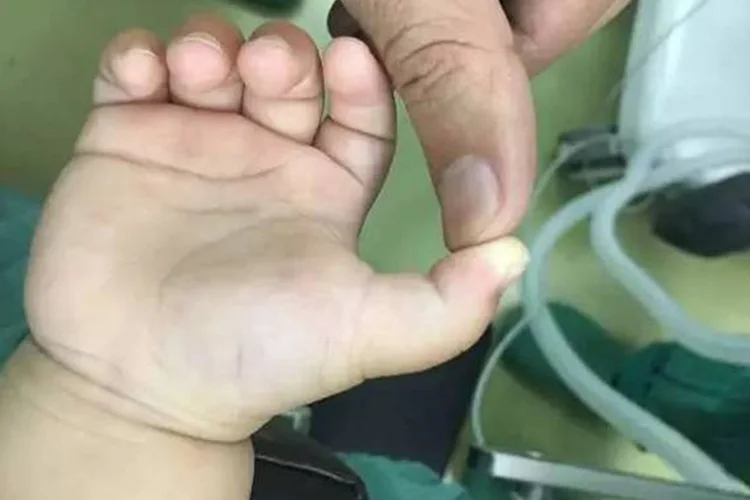 小儿先天性腱鞘炎图片
