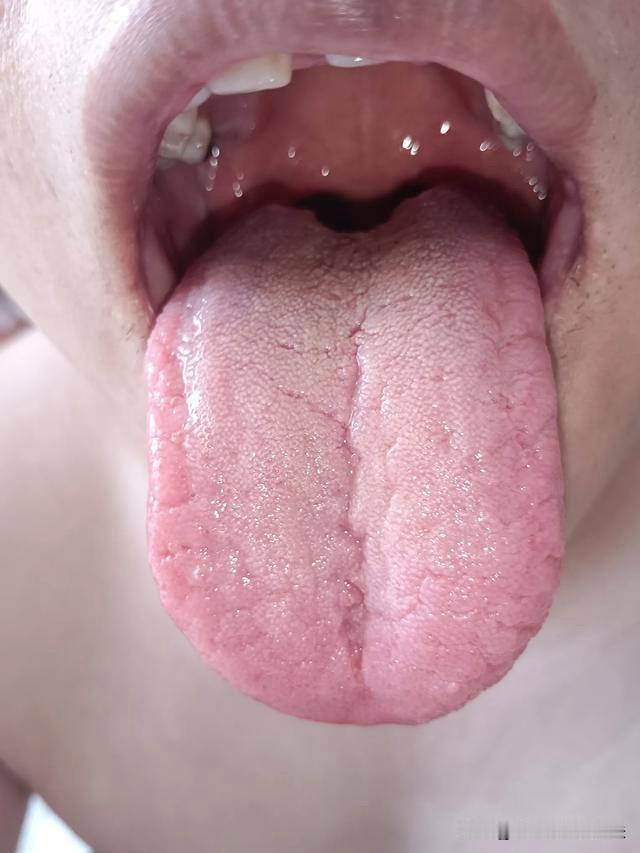 出现这种舌苔，还在健脾补脾，听我一句劝吧弟弟，对你真的是够无语了！

不啰嗦，直