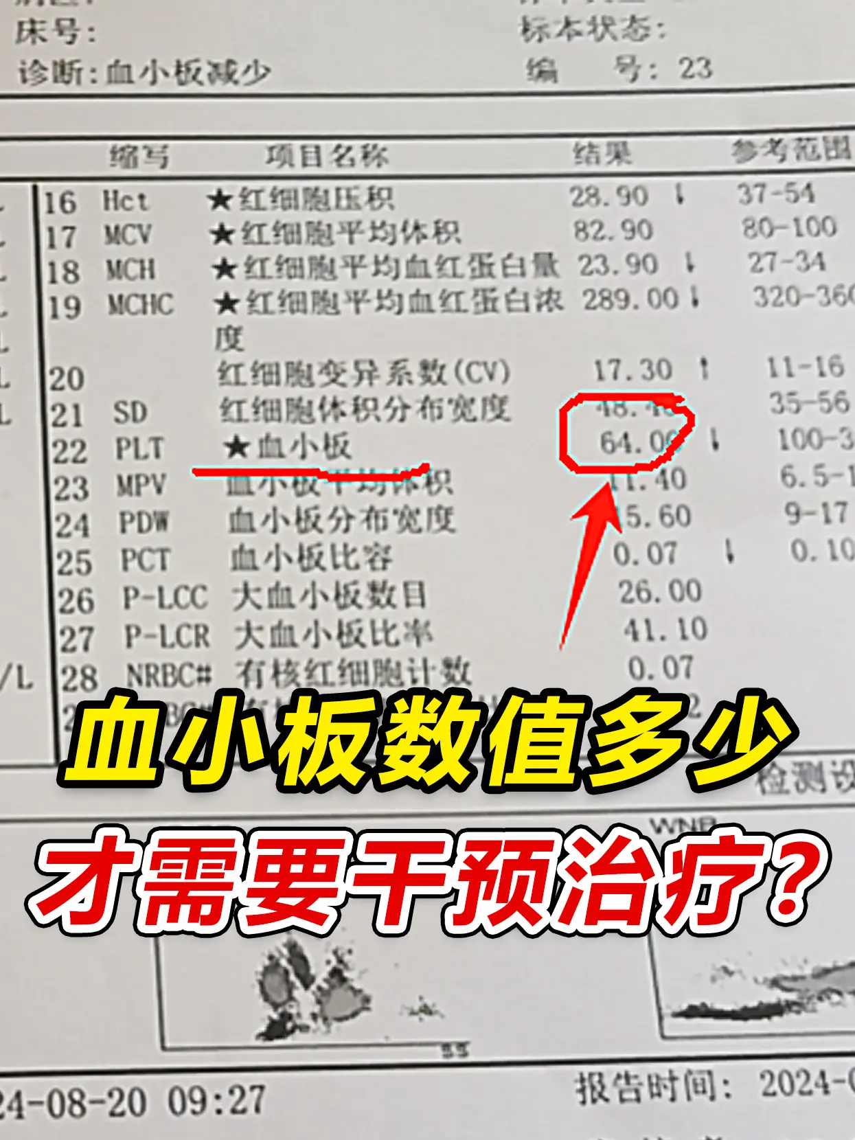 中医认为血小板減少是一种虚症，主要以脾肾阳虚，气血两虚，肝肾阴虚为主...