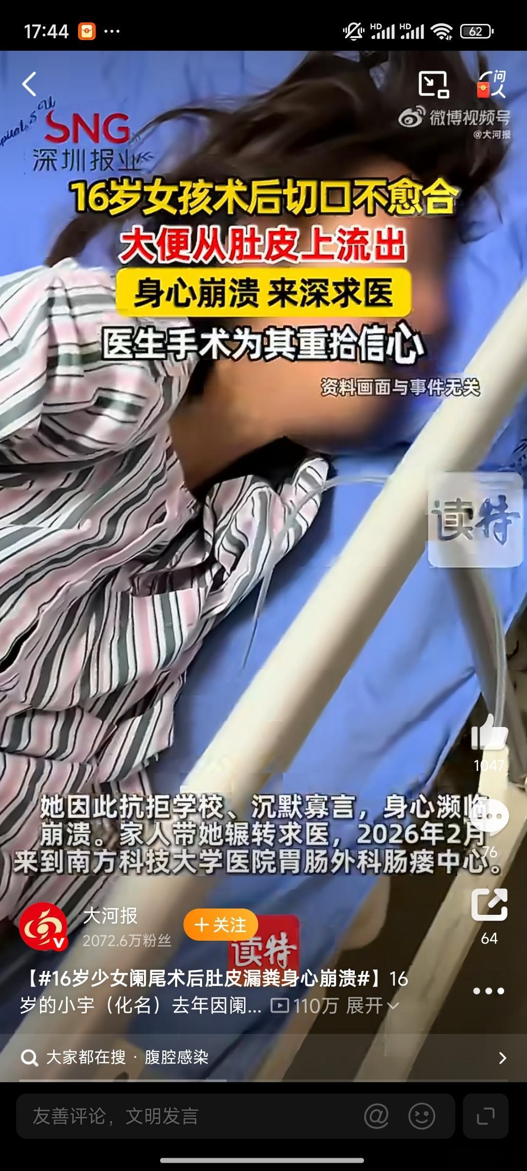 16岁少女阑尾术后肚皮漏粪身心崩溃一场普通阑尾手术，却让花季少女遭遇肠瘘、腹壁漏