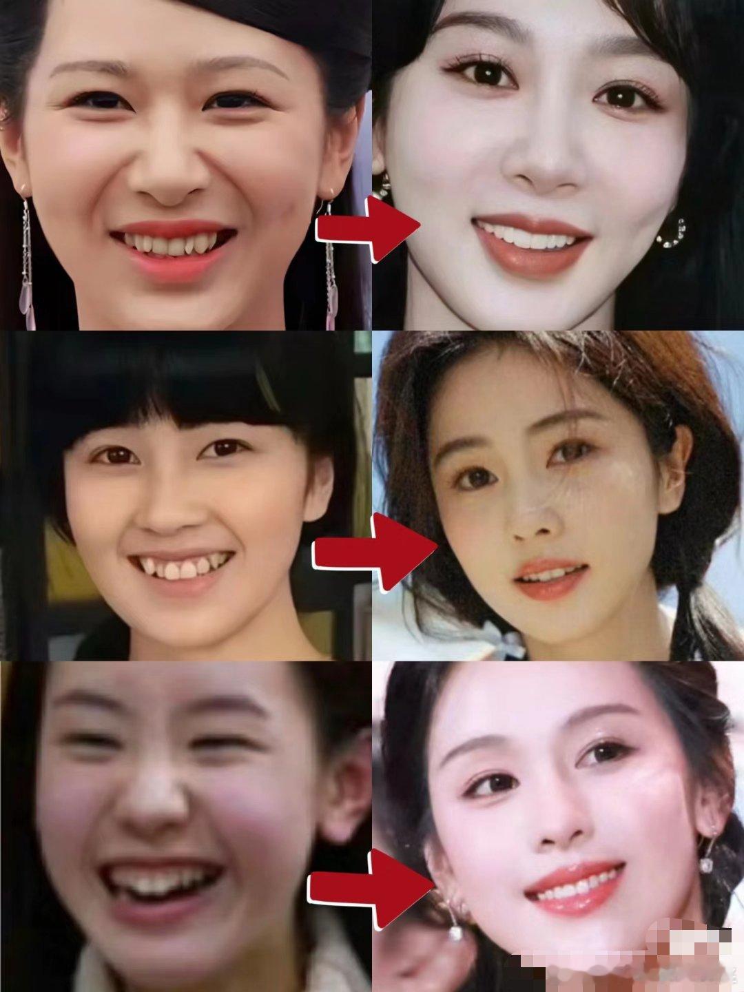 整牙真的好重要，牙齐了感觉人都变美了 ​​​