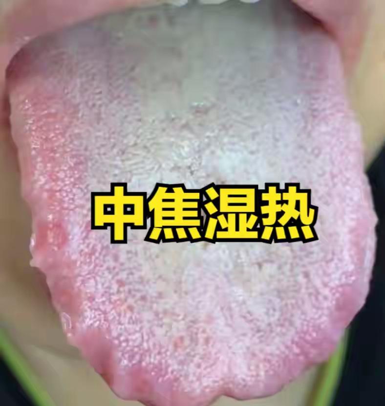 三妙汤+茵陈蒿汤加减：专攻中焦湿热，清脾胃、复中气、充宗筋
大家好，我是陈大夫。