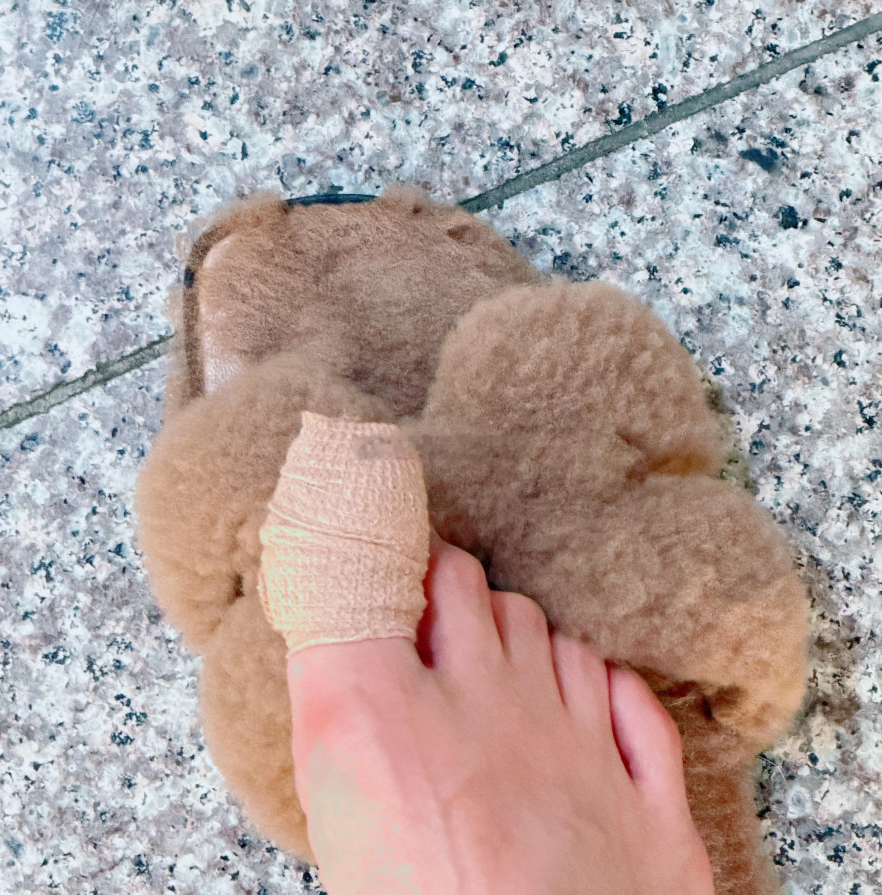跑步把自己跑成甲下淤血了