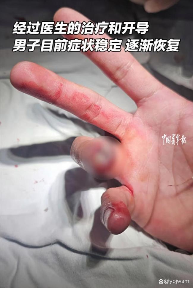 厨房切伤手指竟成“闯关”？晕血男子就医路字字揪心
 谁能想到，切菜这点家常事，能