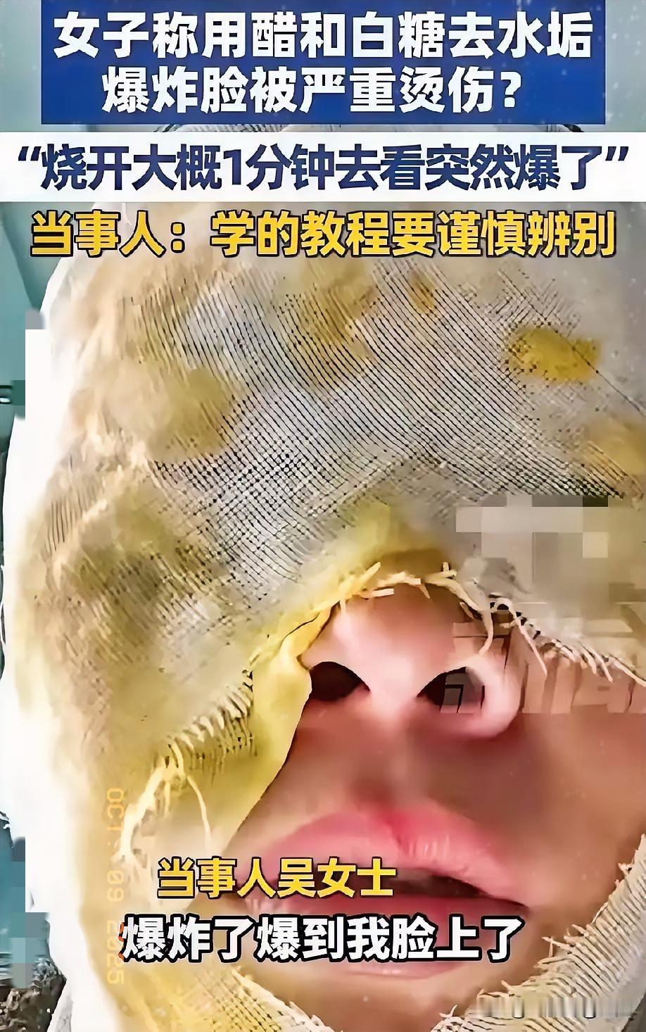 女子清洗水垢被炸伤！切记：糖升温！醋生气！河北一女子用糖和白醋去水垢，水开后停了