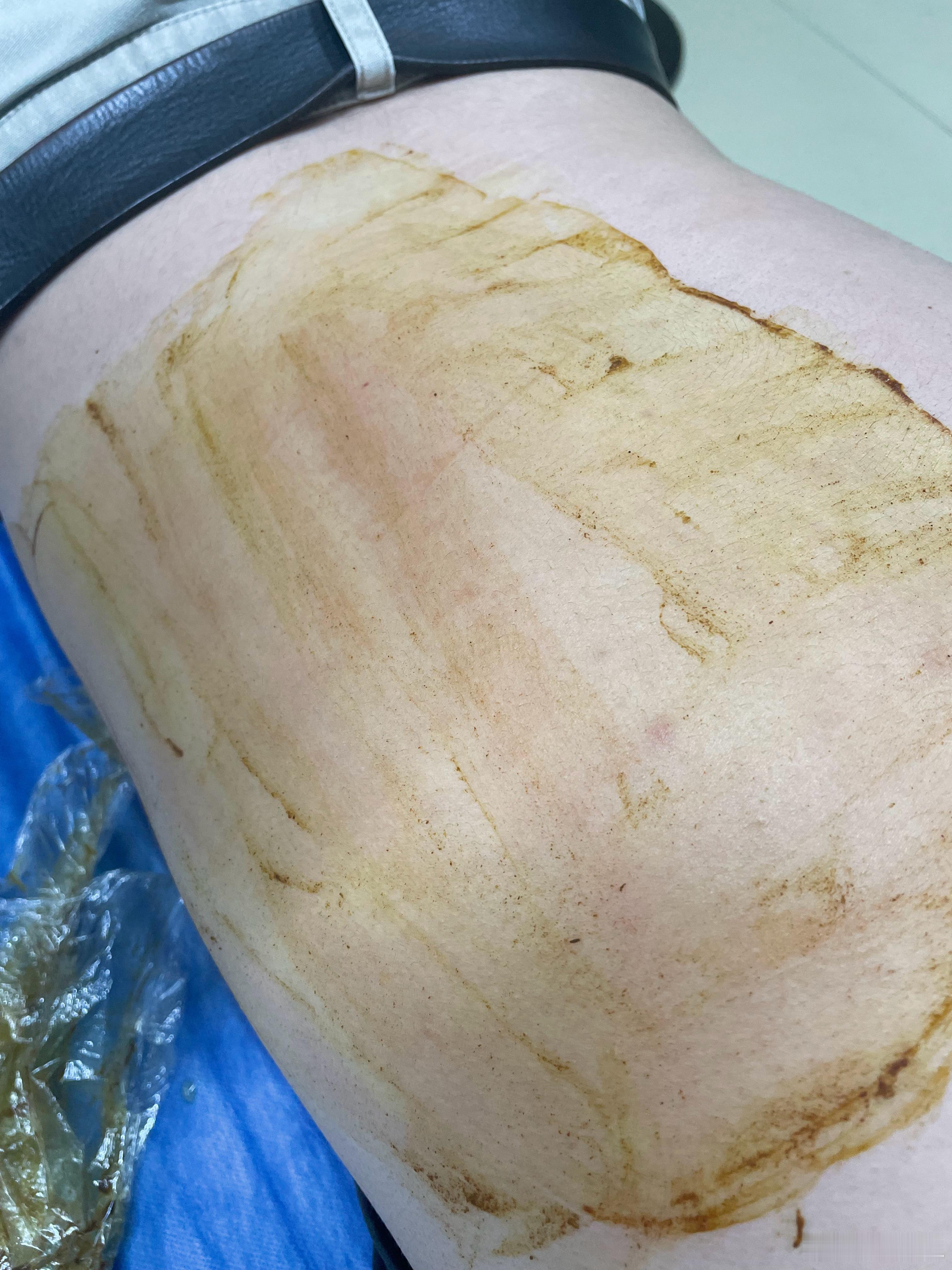 哦豁，拳击事业又要暂停一下了。最近觉得右边背有点痛，今天下班找了个中医诊所看了一