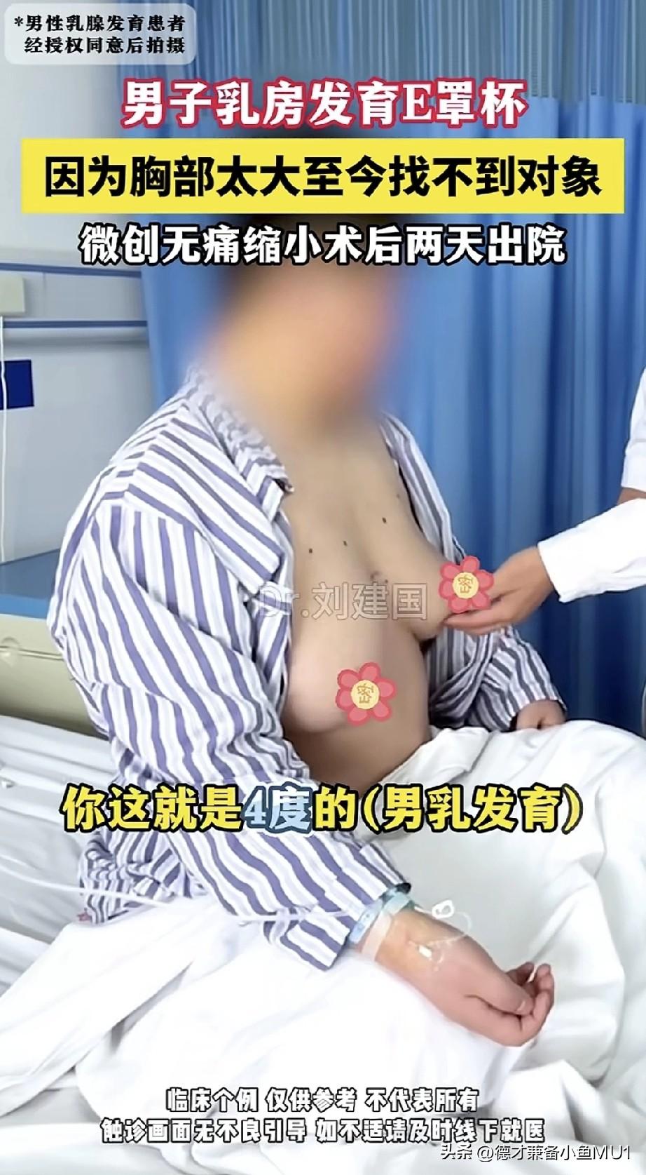 男子乳房发育到E罩杯，因胸部过大多年找不到女朋友而发愁，无奈之下只能到医院做微创