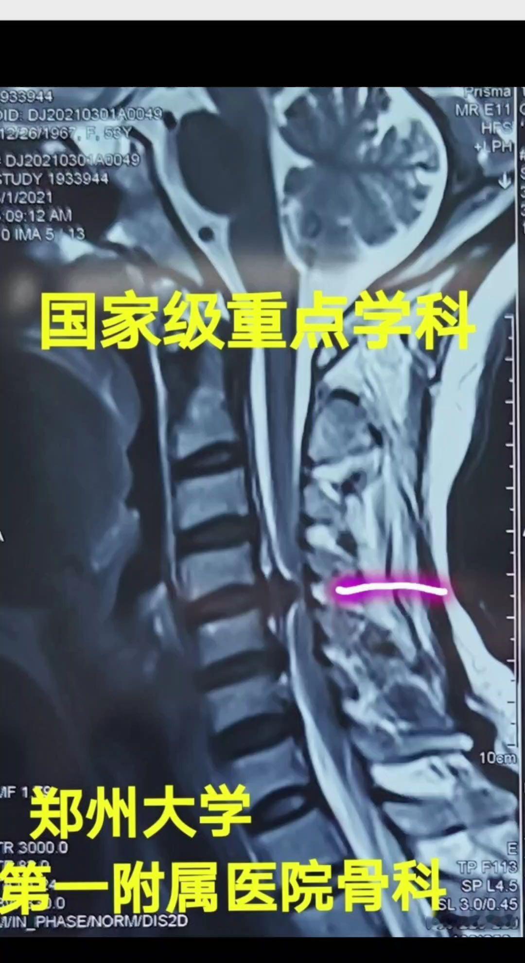 最重的颈椎病，手术后三天恢复正常，七天出