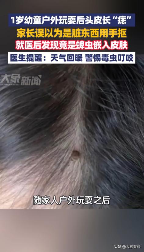 “太吓人了！”近日，湖南，一位一岁多的宝宝随大人在户外玩耍后，晚上被发现头上有个