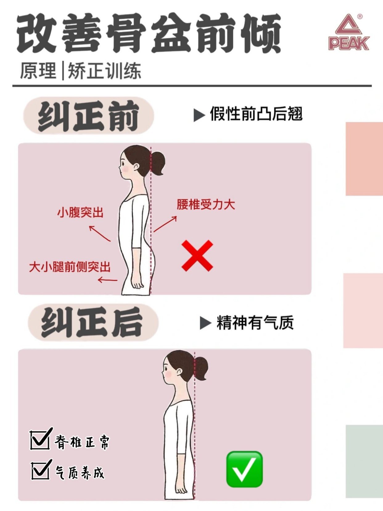 #有一种小肚子叫骨盆前倾#🔥纠正体态，6招有效改善骨盆前倾！！✏️什么是骨盆前