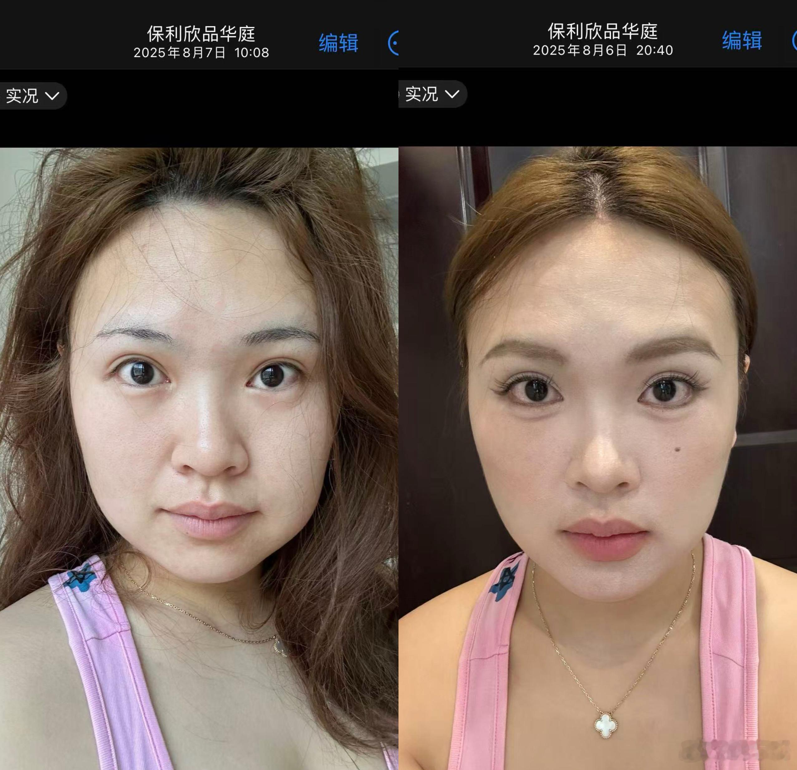 没弄虚作假一点，全是原相机没有p吃了微咸的夜宵水肿是p1吃了火锅烧烤的水肿是p2