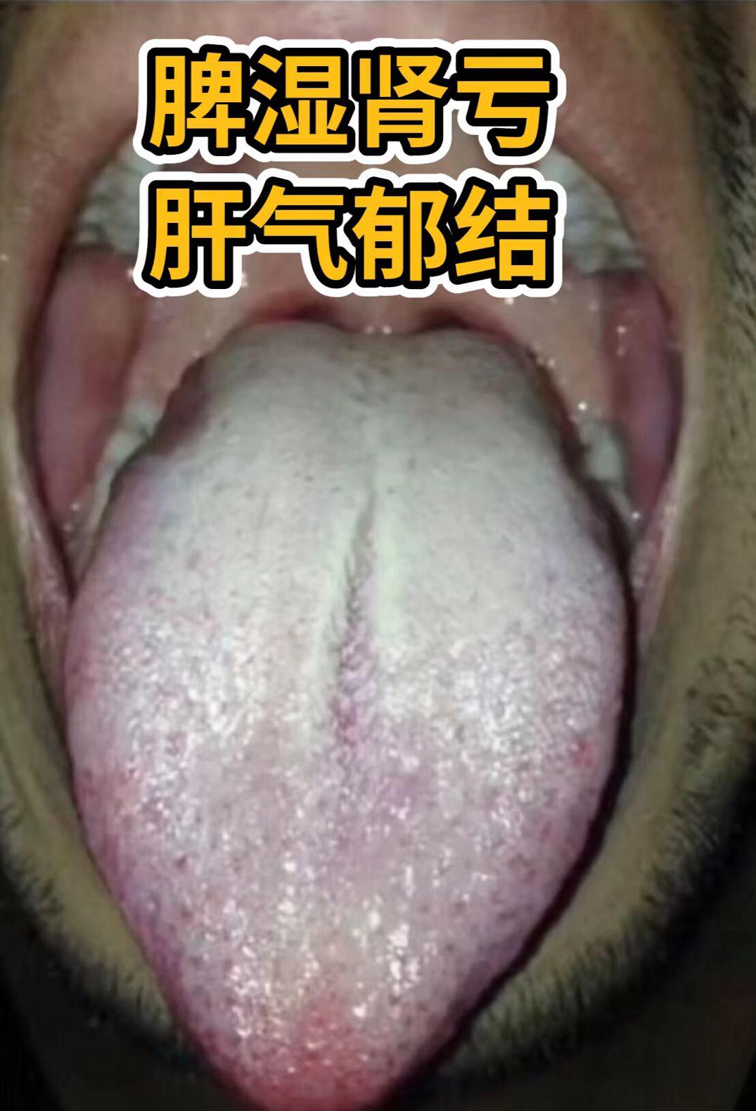 脾虚舌进来看看你是那种