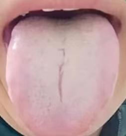 这么典型的脾虚痰湿舌象，为什么用二陈丸、参苓白术丸却没效果？

有个粉丝来找我看