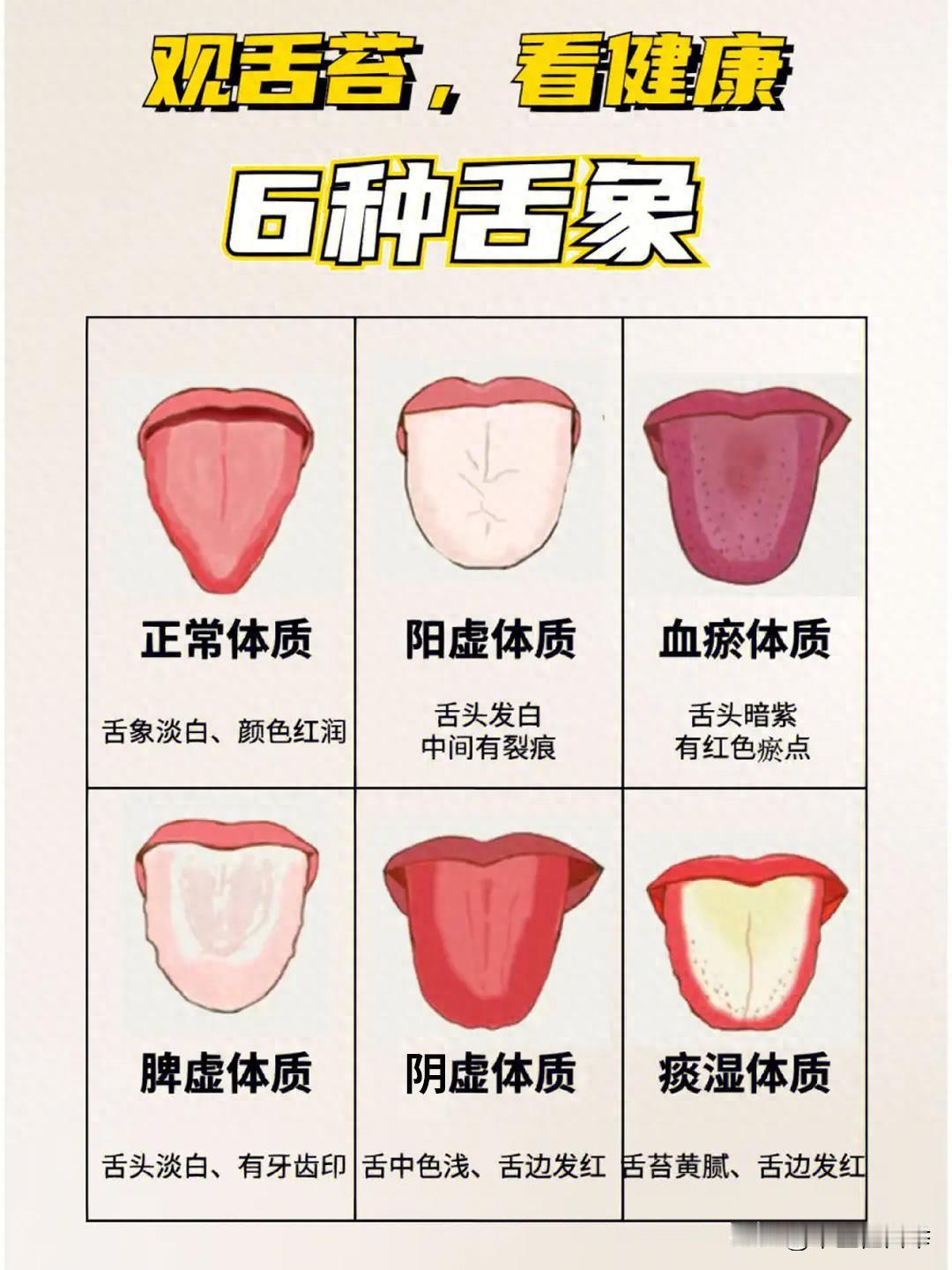 阳虚、阴虚、脾虚、痰湿、瘀血的舌头都是怎么样的，教你一分钟学会看舌象
正常舌象：