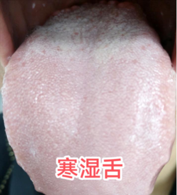寒湿、痰湿、湿热，分不清？今天一次总结好，让你一看便知！

①寒湿---舌质淡，