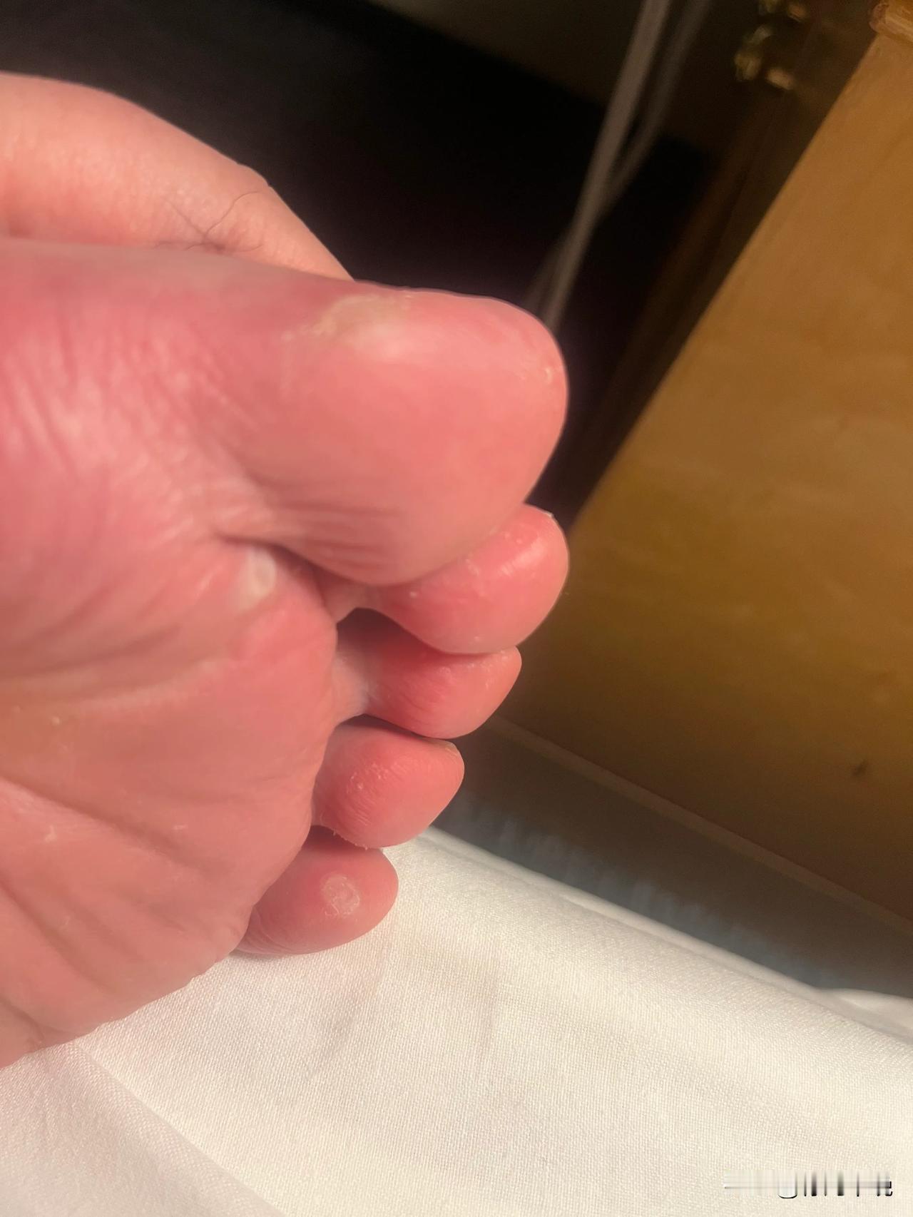 要了血命了（请用威海乡音读）

这辈子头一次一下磨出这么多水泡
请不要问我体重多
