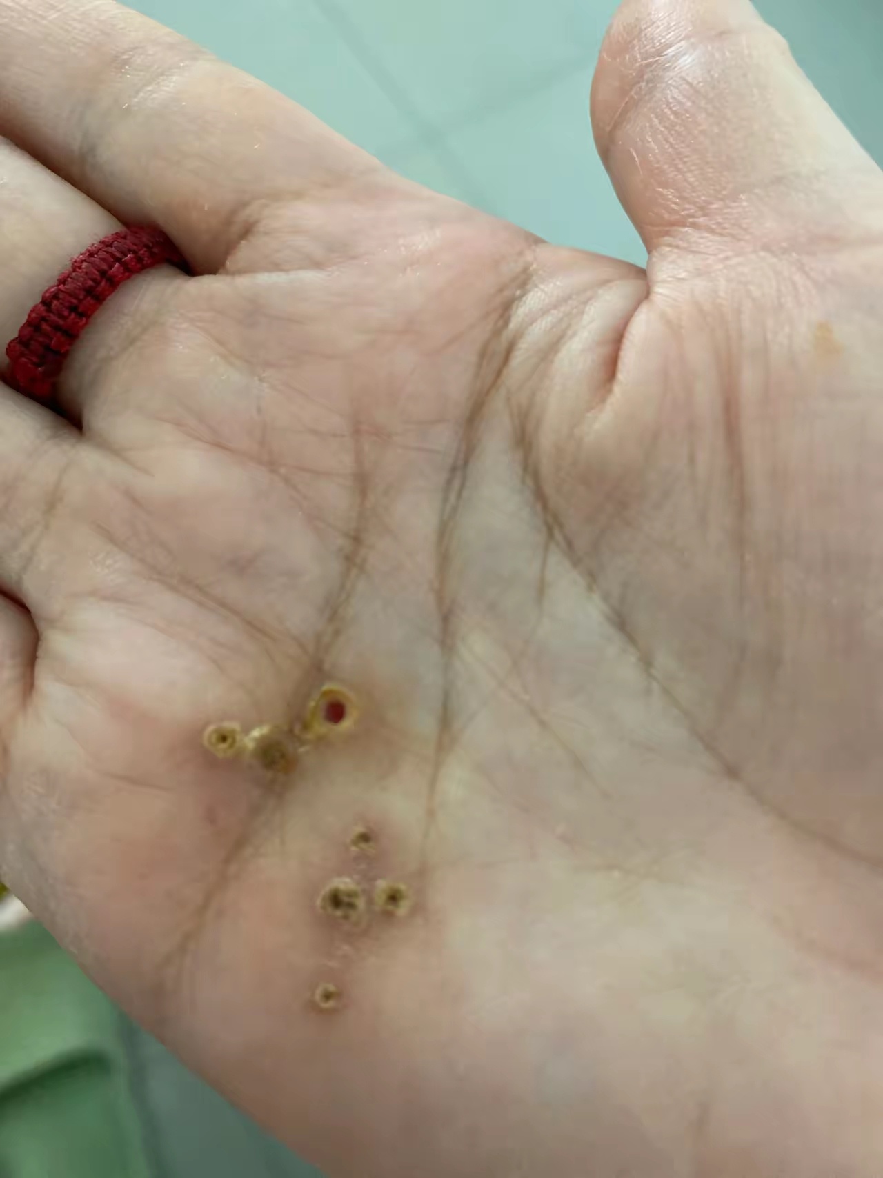 网友：手上长鸡眼了，去一个美容院用药膏给我抹然后挖的，当时挖的挺深，结痂以后让我