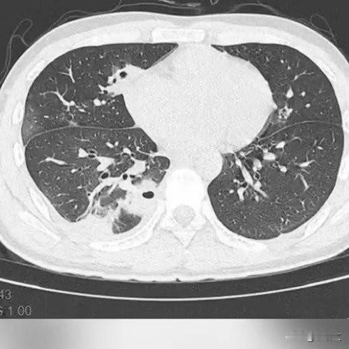 20岁男生挤颗痘险丢命，肺被啃出10多个空洞，危险三角区真碰不得
 
谁能想到挤