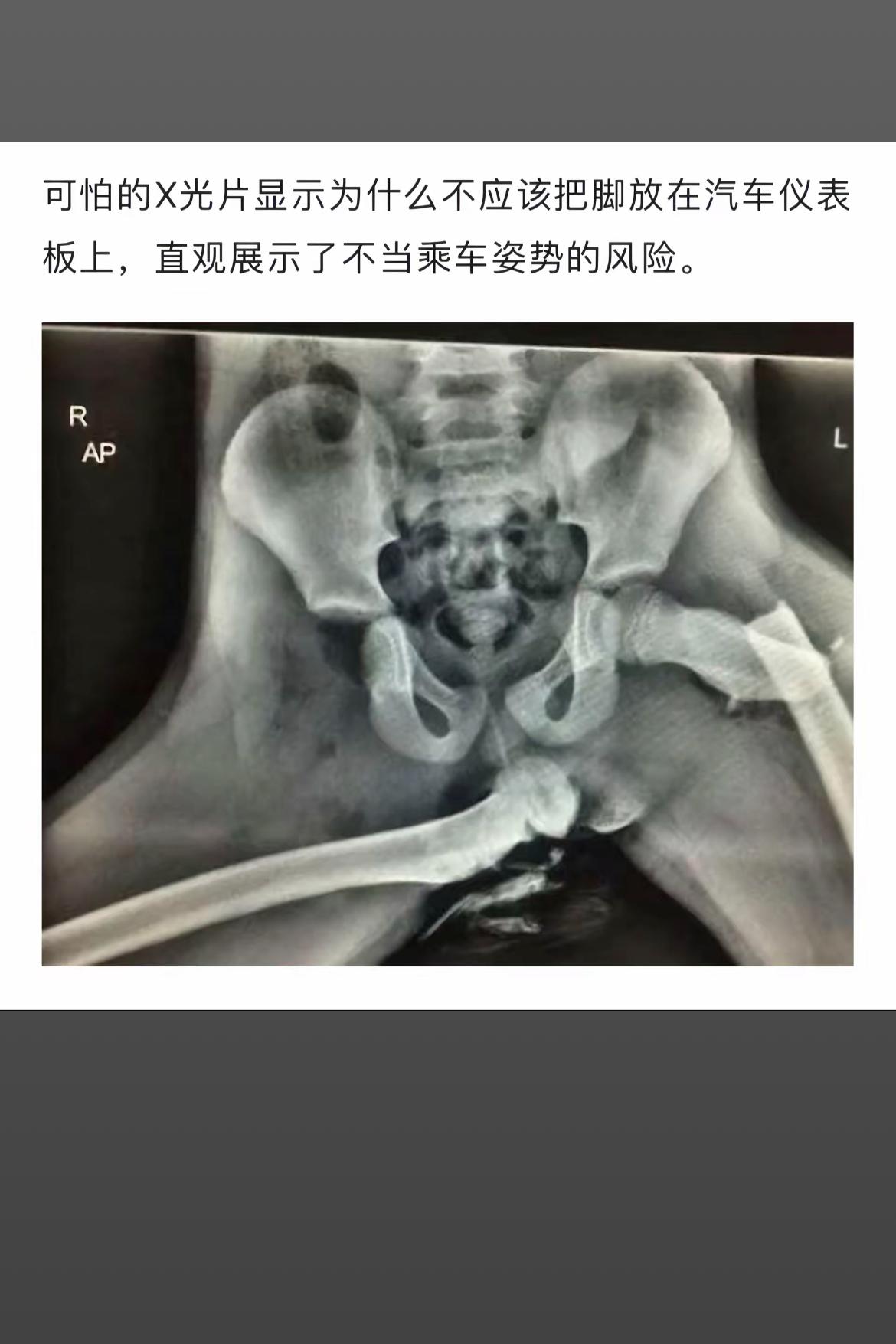 🚗 当心！不正确的乘车姿势，X光片告诉你后果！🚫💢