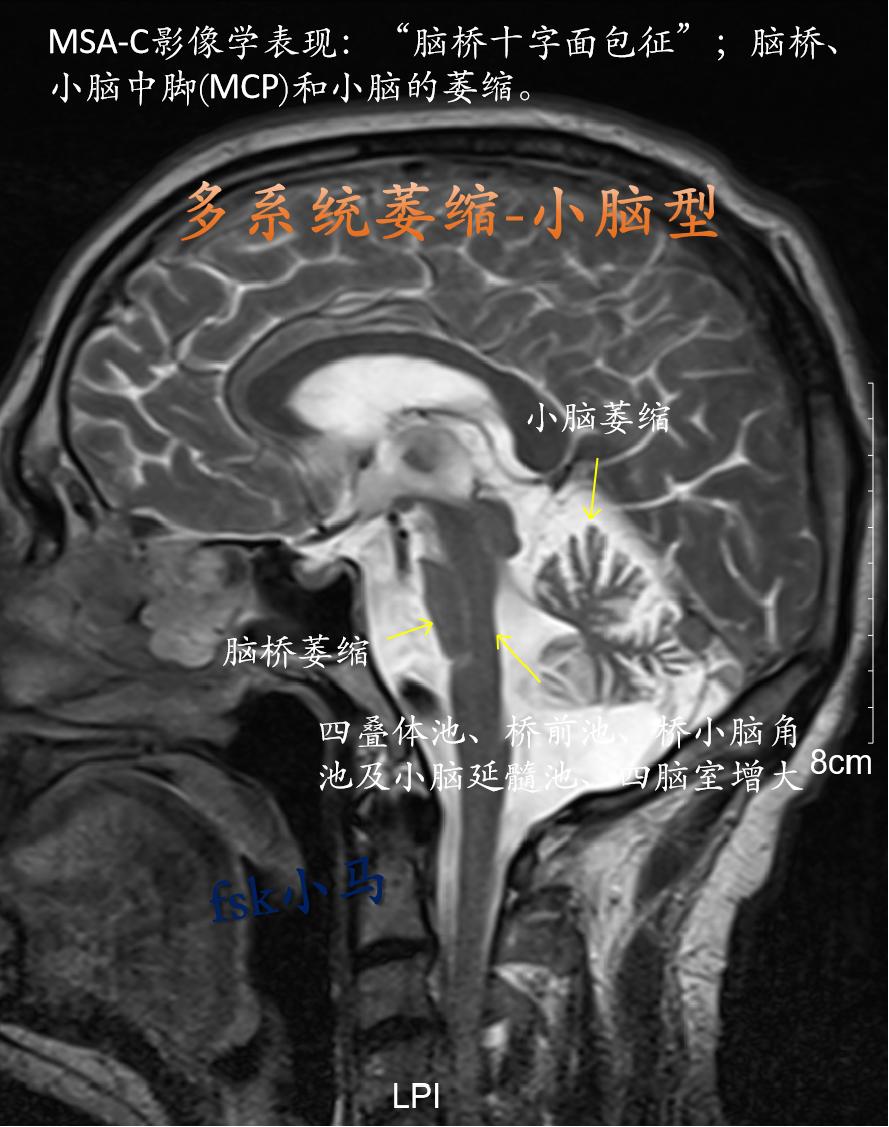 多系统萎缩(MSA)是一种成年起病的严重的神经系统退行性疾病，临床表现...