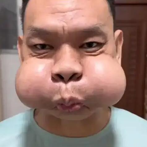 广东男子在工厂吹玻璃长达30年，经过长时间的高温和吹制工艺，导致腮帮子变大，肌肉
