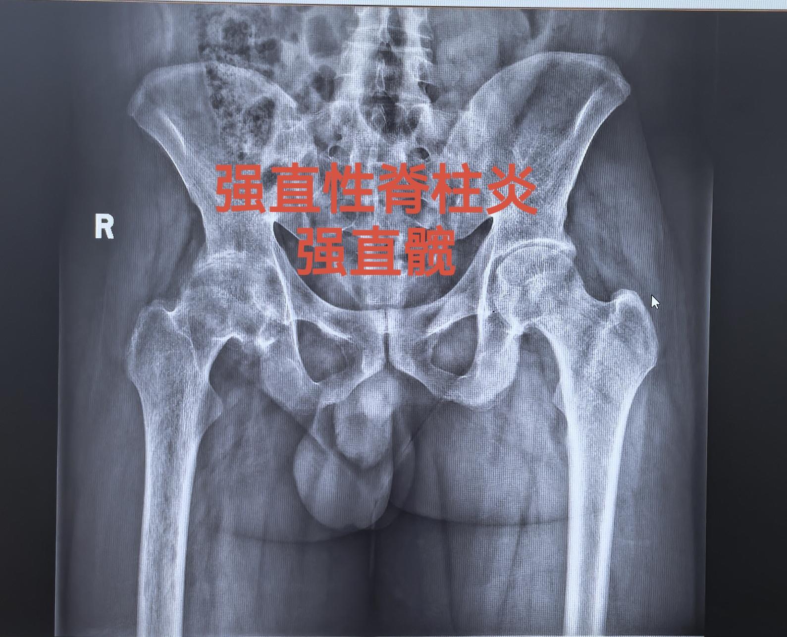 强直髋。强直髋，髋关节无活动度，如有条件，尽早手术，拖得越久，软组织越...