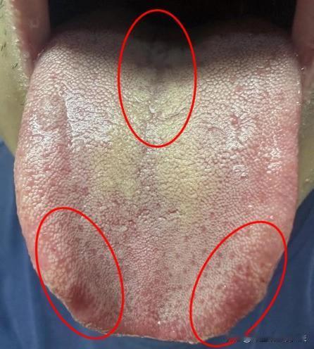阴囊潮湿、宗筋不振，多是下焦湿热了，教你1招：补肝脾、祛湿热！
这位粉丝平时呢，