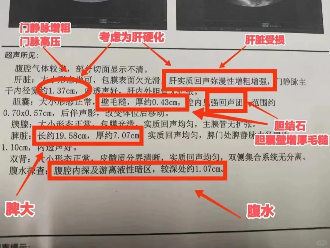 肝脏彩超怎么解读！
