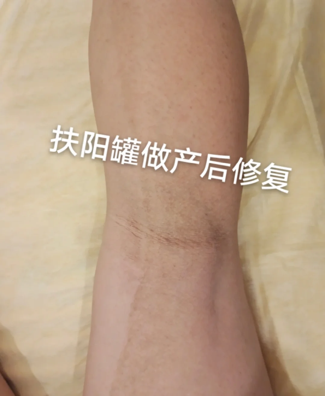 生完娃膝盖后侧暗沉发黑真的自卑哭😭孕