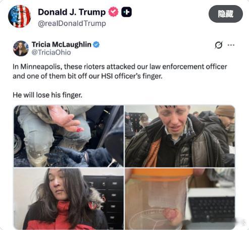【黄金时代】川普证实，左翼分子在明尼阿波利斯咬掉了一名国土安全部官员的手指。“他
