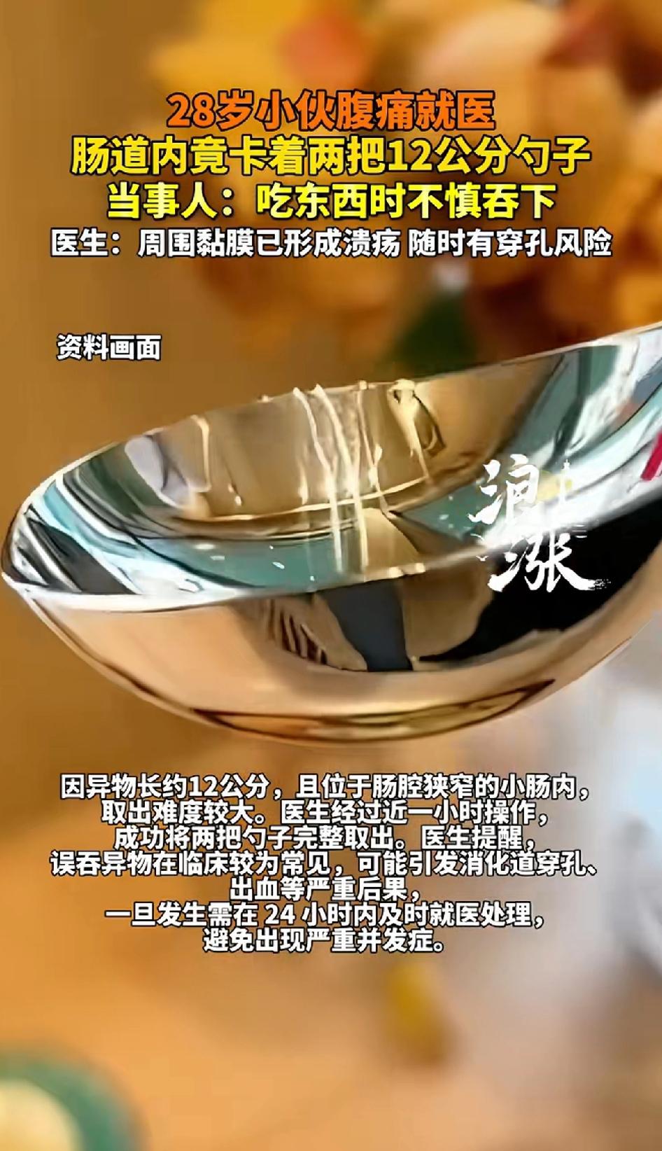 28岁小伙腹痛就医肠道内竟卡着两把12公分勺子！当事人吃东西时不慎吞下。
这事儿