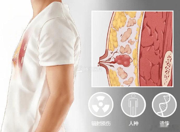 【 为何男性也会被乳腺癌盯上 】 男性身体出现5个信号当心乳腺癌 广东的余先生从