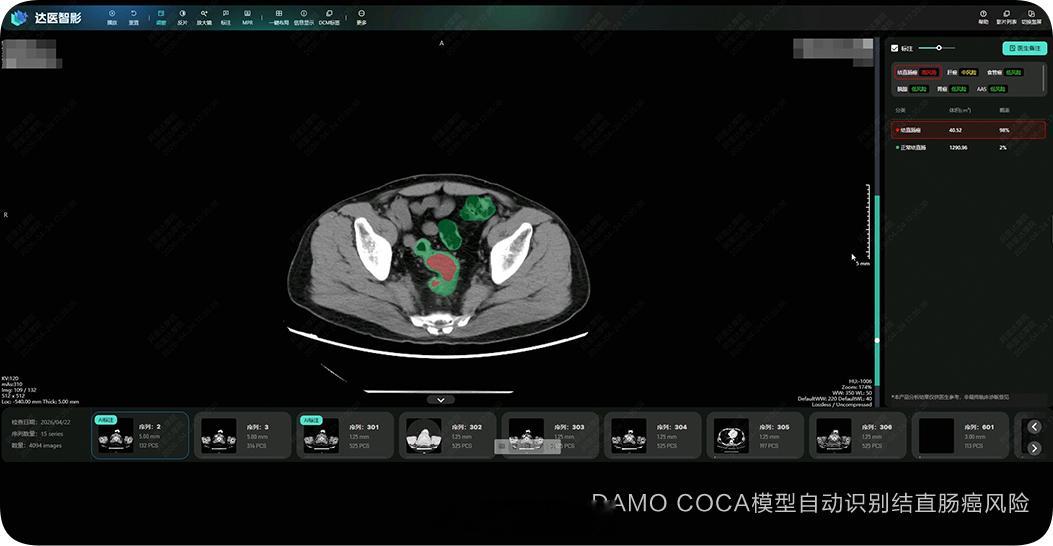 阿里达摩院AI实现肠癌“无感”检测，至此已发布三个癌症筛查AI模型4月28日消息