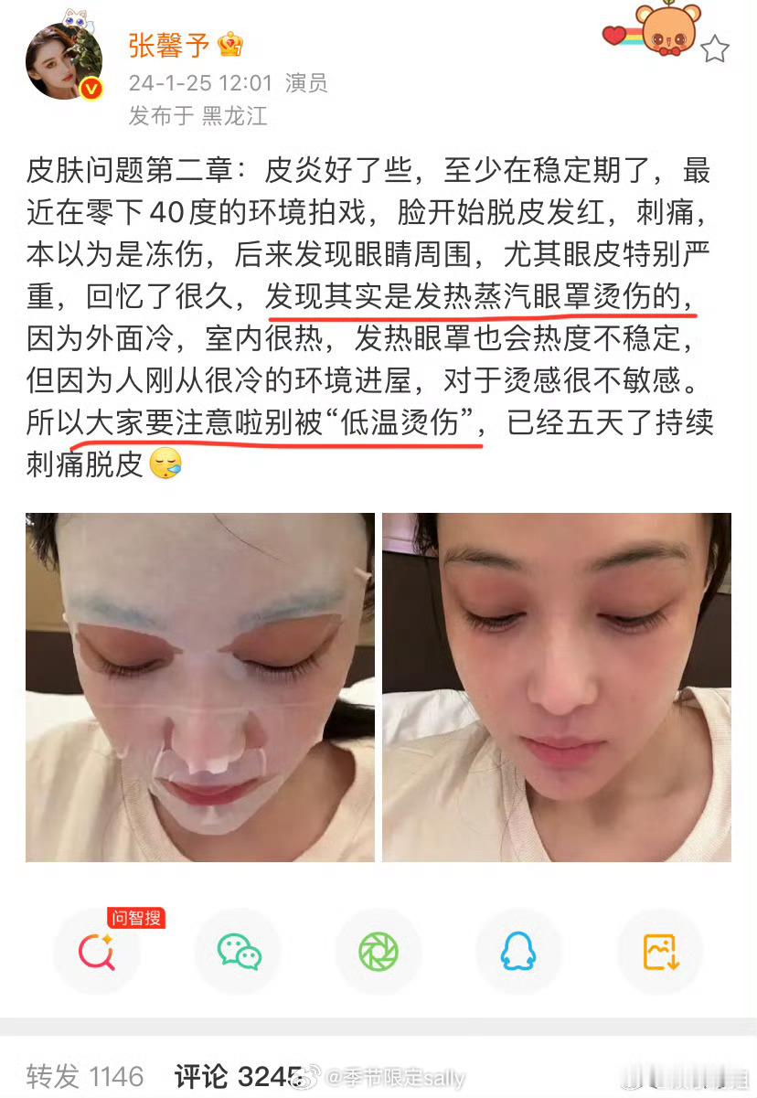 张馨予也被蒸汽眼罩烫伤过，回复杨幂说，小心低温烫伤