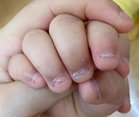 孩子总咬指甲？别急着补锌！
生活中多数家长发现孩子频繁咬指甲，第一反应便是孩子缺