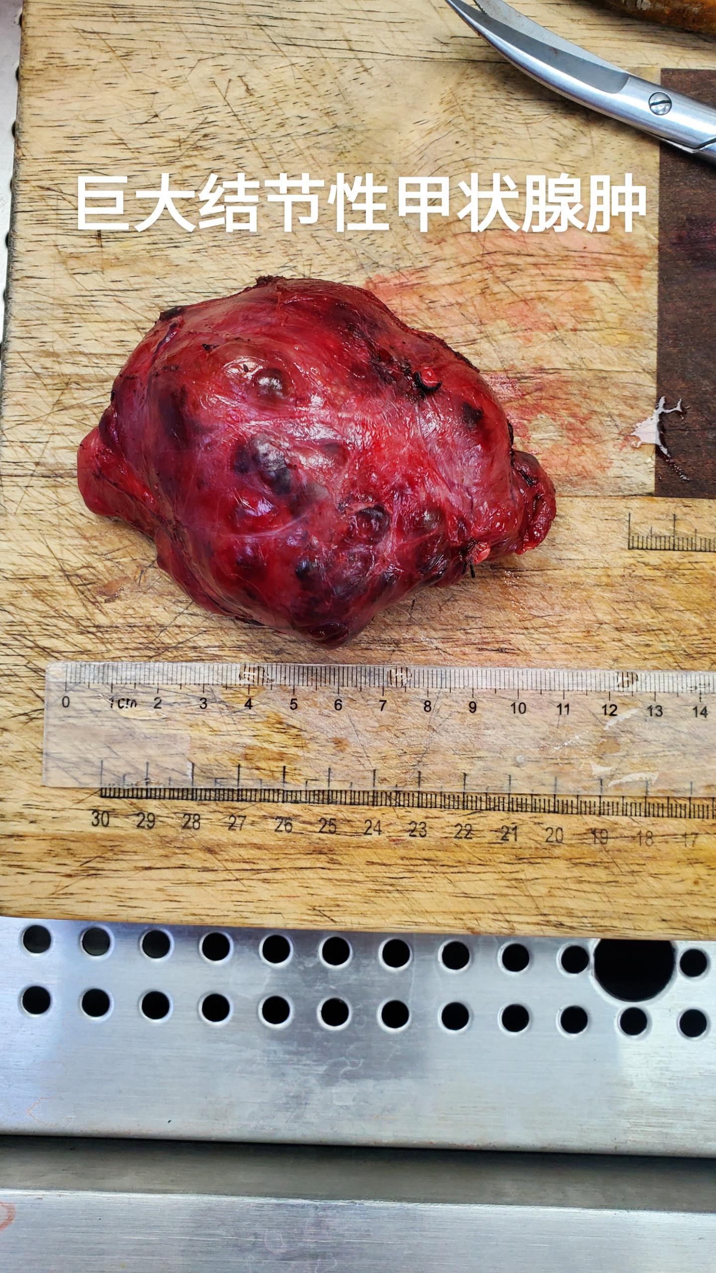 结节性甲状腺肿