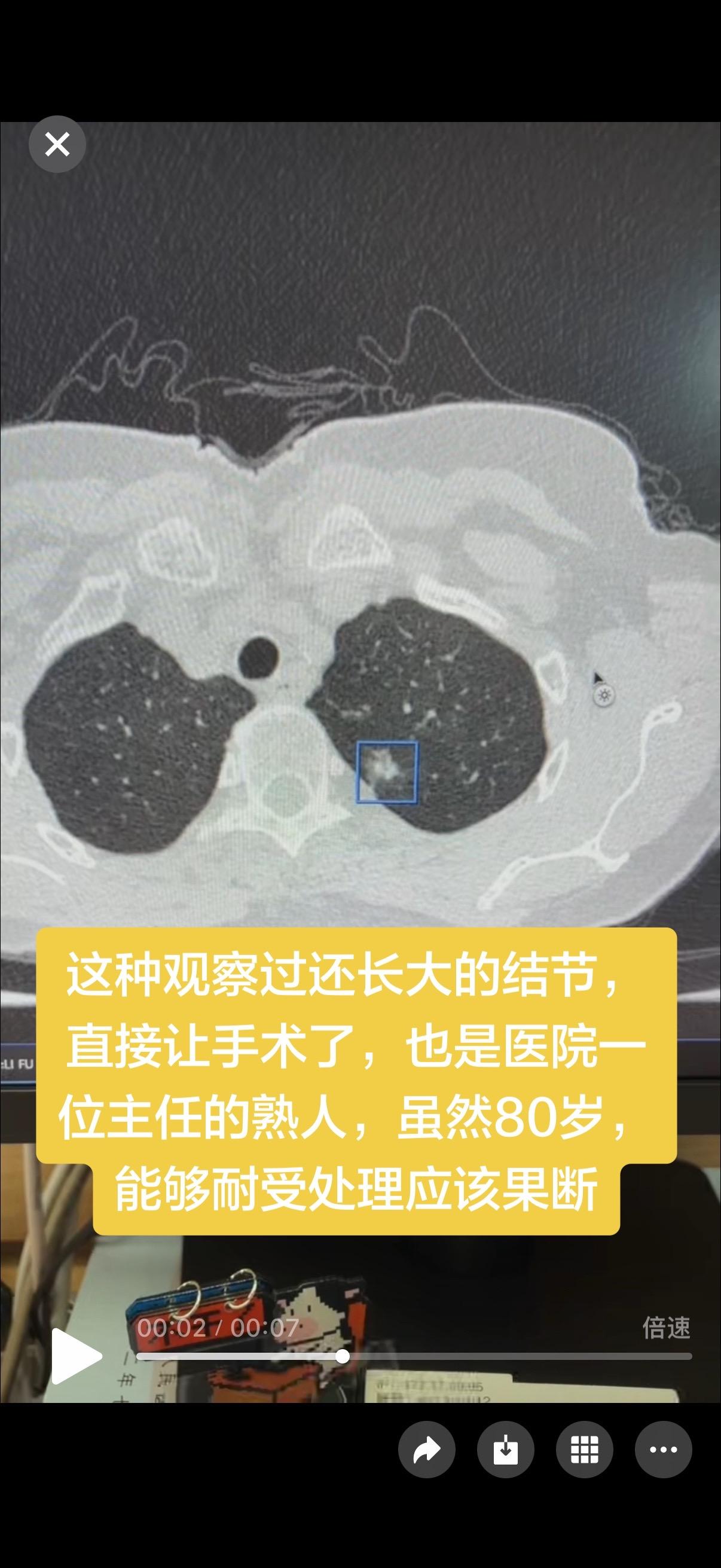 这种观察过还长大的结节，直接让手术了，也是医院一位主任的熟人，虽然80...