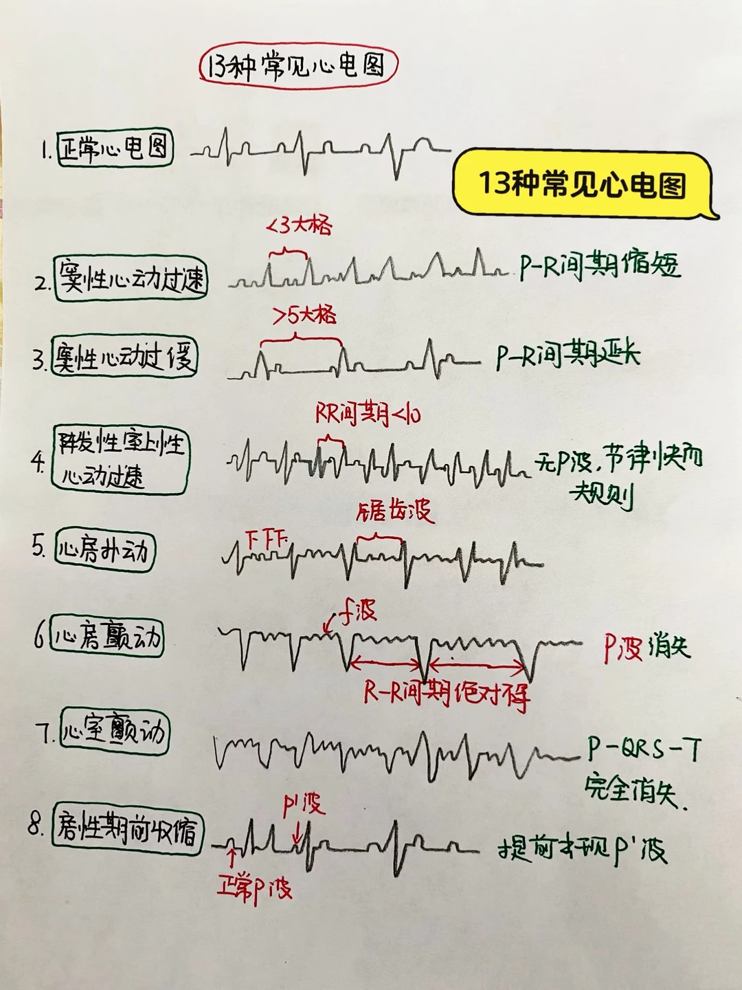 今日学习打卡——13种常见心电图