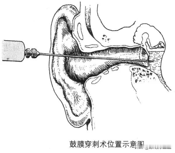 鼓膜穿刺是指用细针在鼓膜紧张部前下或后下象限进行穿刺，把中耳腔内的积液抽出，冲洗