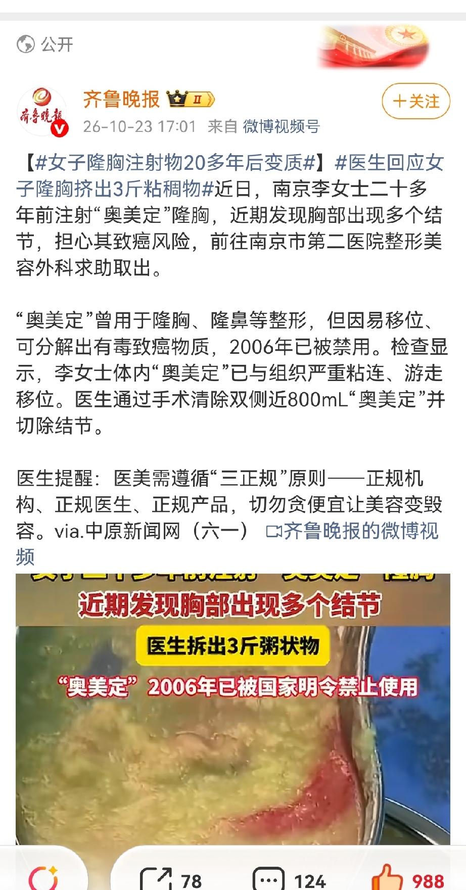 南京一位女士，二十多年前做过奥美定注射隆胸。当时这款医美材料非常火爆，价格便宜、