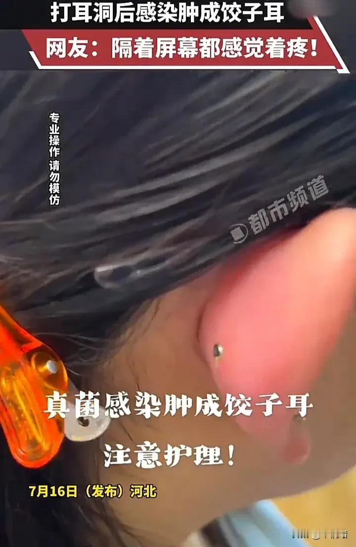 隔着屏幕都能感觉到疼！7月17日，河北一名女子发视频称，自己去打完耳洞后，由于没