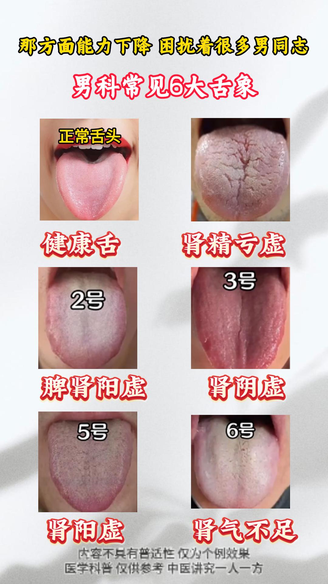 男常见6大舌象，你是哪一种？。