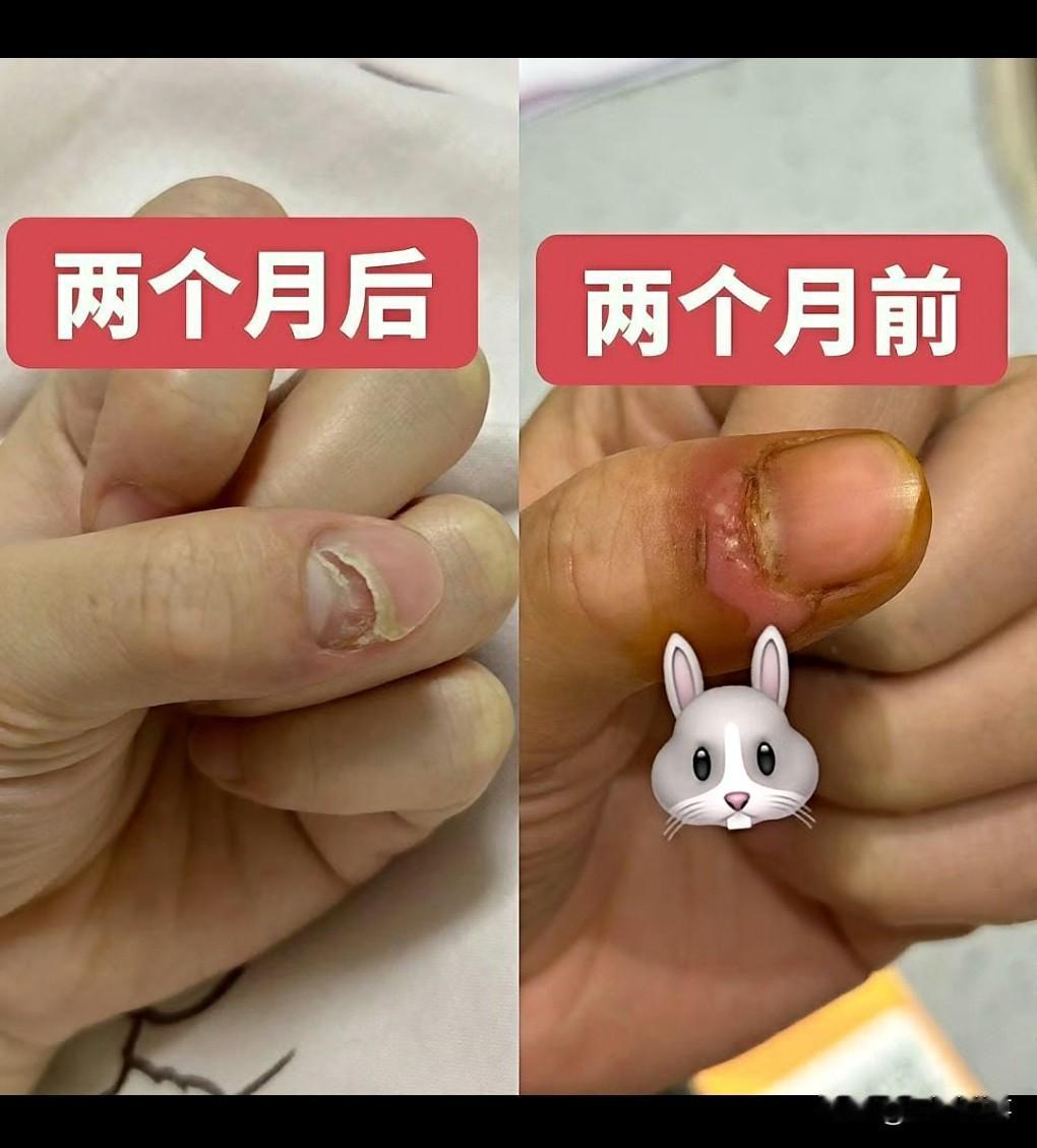这真是太可怕了，千万不要再拔倒刺了，后果承担不起呀。
近日一网友称，她拔倒刺指甲