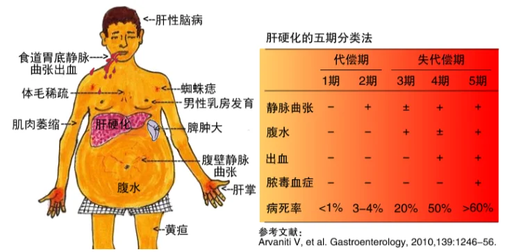 为什么肝硬化失代偿期比肝癌还严重？