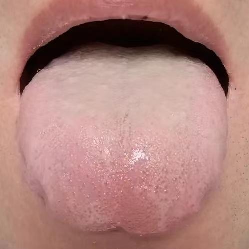 舌根白腻成这样，下焦一片虚寒，难怪阳 事不兴！
前两天有一位粉丝给我发了他的舌象