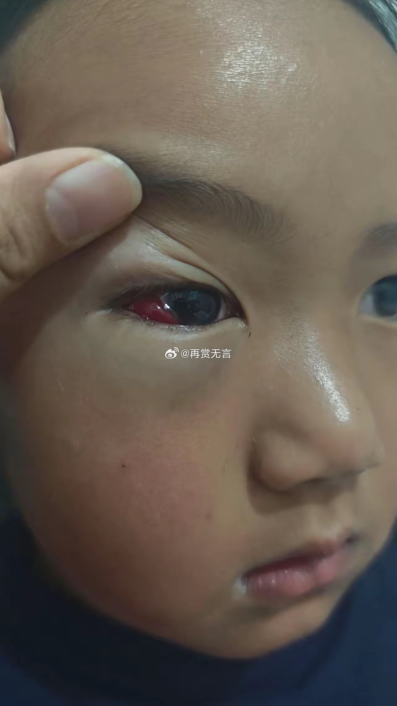 萌娃这是重击血肿了，应该是拳头打的 